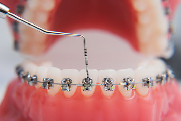 Braces Adjustment